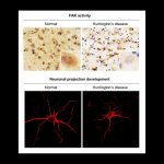 Causes of brain dysfunction in patients with Huntington’s disease explained