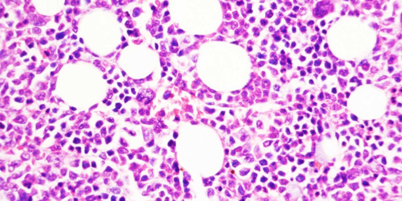 Chronic blood cancer transition to aggressive disease revealed