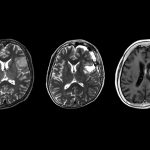 Worse outcome for patients with rare type of astrocytoma