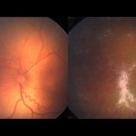 AI breakthrough in detecting leading cause of childhood blindness