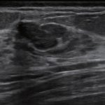 CAD improves breast ultrasound expertise